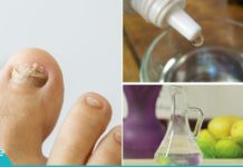 3-ინგრედიენტიანი საშუალება ფრჩხილის სოკოს სამკურნალოდ