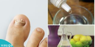 3-ინგრედიენტიანი საშუალება ფრჩხილის სოკოს სამკურნალოდ