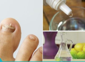 3-ინგრედიენტიანი საშუალება ფრჩხილის სოკოს სამკურნალოდ