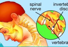 როგორ მოვიშოროთ მარილები კისრის მიდამოში?!