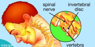 როგორ მოვიშოროთ მარილები კისრის მიდამოში?!