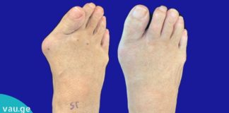 საშინაო მეთოდები ბურსიტის სამკურნალოდ.