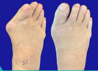 საშინაო მეთოდები ბურსიტის სამკურნალოდ.