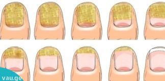 ნატურალური მეთოდი ფეხებზე ყვითელი ფრჩხილების სამკურნალოდ.