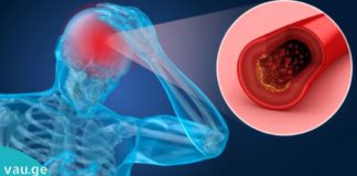 გულის შეტევა, ინსულტი, თრომბოფლებიტი, ვარიკოზული ვენები, ბუასილი … რა საერთო აქვს ამ ყველა დაავადებას?