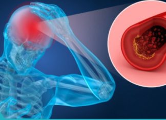 გულის შეტევა, ინსულტი, თრომბოფლებიტი, ვარიკოზული ვენები, ბუასილი … რა საერთო აქვს ამ ყველა დაავადებას?