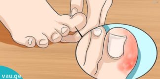 საუკეთესო ხალხური საშუალებები ფრჩხილების სამკურნალოდ-ცდად ღირს