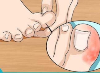 საუკეთესო ხალხური საშუალებები ფრჩხილების სამკურნალოდ-ცდად ღირს