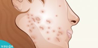 3-ტოპ ნიღაბი აკნეს სამკურნალოდ