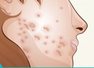 3-ტოპ ნიღაბი აკნეს სამკურნალოდ