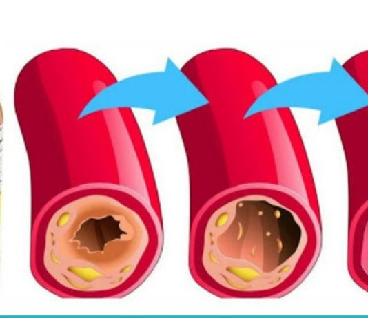 შესანიშნავი საშუალება მაღალი წნევისა და ცუდი ქოლესტერინის დროს