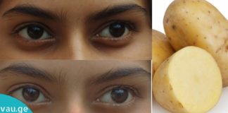 კარტოფილის და თაფლის ნიღაბი თვალებქვეშ შავი ლაქების გასაქრობად