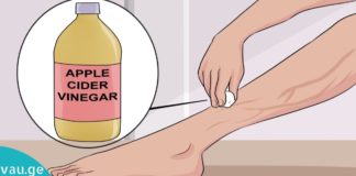 ხალხური მედიცინის რეცეფტები ვარიკოზის სამკურნალოდ!