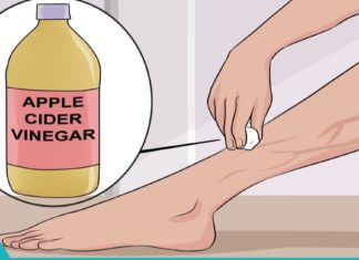 ხალხური მედიცინის რეცეფტები ვარიკოზის სამკურნალოდ!