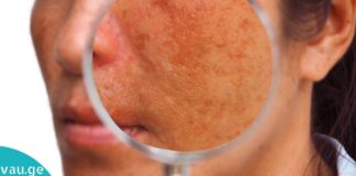 6 მარტივი და ეფექტური საშინაო სამკურნალო საშუალება პიგმენტაციის სამკურნალოდ.