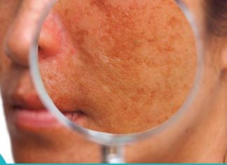 6 მარტივი და ეფექტური საშინაო სამკურნალო საშუალება პიგმენტაციის სამკურნალოდ.