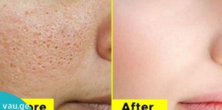 ნატურალური საშუალებები გაფართოებული ფორების შესამცირებლდ