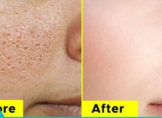 ნატურალური საშუალებები გაფართოებული ფორების შესამცირებლდ