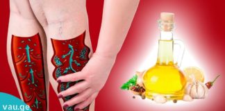 მოამზადეთ ნიორის მალამო ვენების გაფართოების დროს.