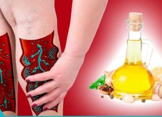 მოამზადეთ ნიორის მალამო ვენების გაფართოების დროს.