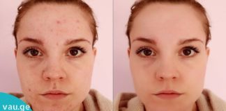 როგორ გავიქროთ გამონაყარი სახლის პირობებში