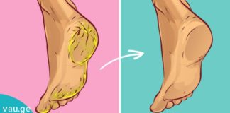 ხალხური მეთოდი დამსკდარი ქუსლების სამკურნალოდ.