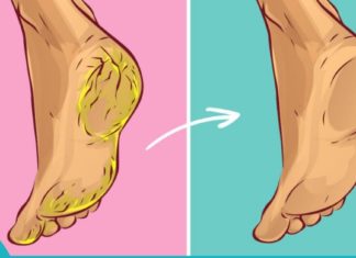 ხალხური მეთოდი დამსკდარი ქუსლების სამკურნალოდ.