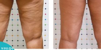 ხალხური მედიცინა დაგეხმარებათ ცელულიტების მოცილებაში