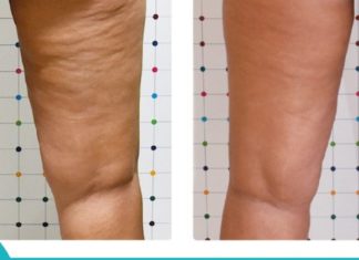 ხალხური მედიცინა დაგეხმარებათ ცელულიტების მოცილებაში