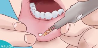 საუკეთესო ბუნებრივი საშუალებები პირის ღრუს წყლულის სამკურნალოდ.