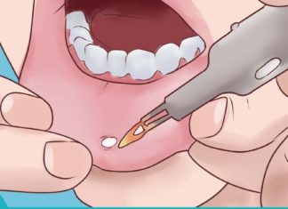 საუკეთესო ბუნებრივი საშუალებები პირის ღრუს წყლულის სამკურნალოდ.