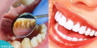 საუკეთესო მეთოდი თუ როგორ გაითეთროთ კბილები და მოიცილოთ  ქვები