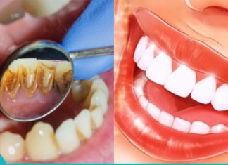 საუკეთესო მეთოდი თუ როგორ გაითეთროთ კბილები და მოიცილოთ ქვები