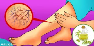 მოიცილეთ ვარიკოზული ვენები სამუდამოდ ერთი ინგრედიენტით!