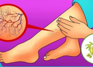 მოიცილეთ ვარიკოზული ვენები სამუდამოდ ერთი ინგრედიენტით!