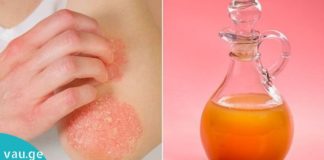 ნატურალური მეთოდები ფსორიაზის სამკურნლოდ