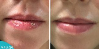 მოამზადეთ ეს ბალზამი, რათა აღარ შეგაწუხოთ დამსკდარმა ტუჩებმა