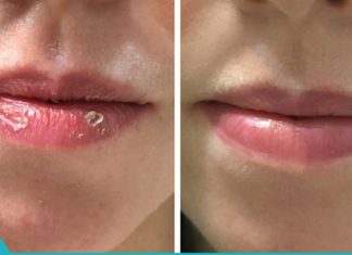 მოამზადეთ ეს ბალზამი, რათა აღარ შეგაწუხოთ დამსკდარმა ტუჩებმა