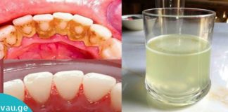 ნატურალური მეთოდები კბილის ქვებთან საბრძოლველად სახლის პირობებში!