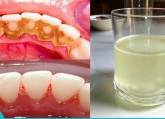 ნატურალური მეთოდები კბილის ქვებთან საბრძოლველად სახლის პირობებში!