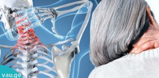 საუკეთეოსო ბუნებრივი საშუალებები კისრის ტკივილისათვის!