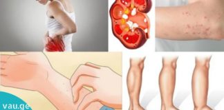 8 სიმპტომი, რომელიც თირკმელების დაზიანებაზე მიუთითებს. ეს უნდა იცოდეთ!