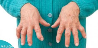 ართრიტის მკურნალობა ხალხური მედიცინით