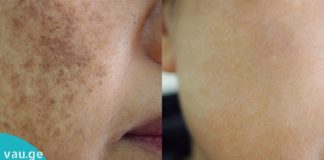 მოიცილეთ პიგმენტალური ლაქები და ნაოჭები მხოლოდ ერთ კვირაში!