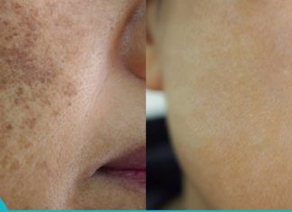 მოიცილეთ პიგმენტალური ლაქები და ნაოჭები მხოლოდ ერთ კვირაში!