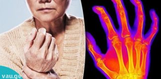 ეფქტური რეცეფტი ართრიტის, ართროზის და სახსრების ტკივილის დროს.