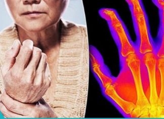 ეფქტური რეცეფტი ართრიტის, ართროზის და სახსრების ტკივილის დროს.