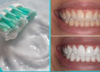 უსაფრთხო კბილების გათეთრება ორი ინგრედიენტით