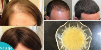 შეიზილეთ ეს მარევი თმის ძირებში და დაივიწყეთ თმის ცვენა