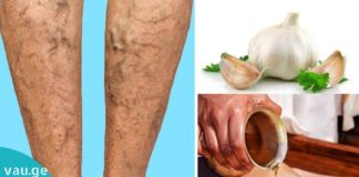 ვარიკოზული ვენების მკურნალობა ხალხური მედიცინით